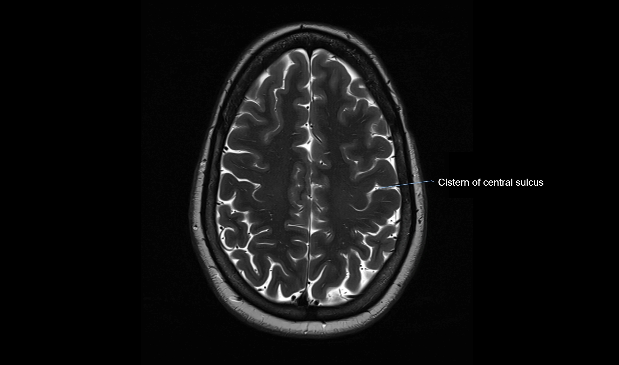 Brain cisterns  and ventricles  axial anatomy 3T MRI image-img-00001-00044.webp